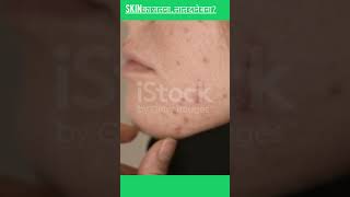 Skin light cream Melas Cream No Scars Cream Uses Review 2023 Sideeffect Noscars cream short [upl. by Leafar]