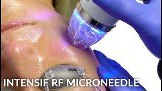 Intensif RF Micro Needling for Acne Scar Treatment  Micro Needling Before and After  Dr Jason Emer [upl. by Heidy532]