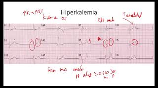 Hiperkalemia EKG [upl. by Lorenz]