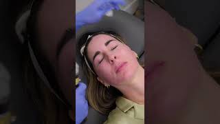 CO2 Laser Treatment with RN Jazmyn at Bay Hills MD – Watch the Transformation [upl. by Jaycee]