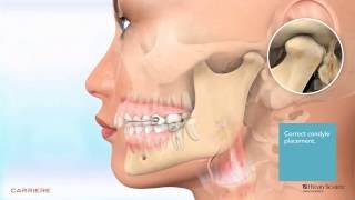 Carriere® Motion™ Appliance for Class II Patient Education Animation 2 [upl. by Cele]