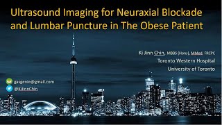 Ultrasound Imaging in Obesity for Epidural  Spinal Anesthesia amp Lumbar Puncture [upl. by Sidnee209]