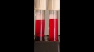 اخطاء عند سحب عينه الدم Effects of Hemolysis on Clinical Specimens [upl. by Ellery]