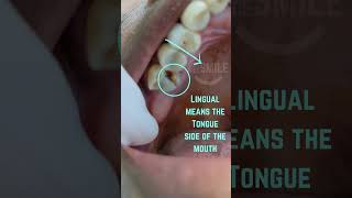 Broken tooth Removed dentist extraction verynicesmiledental [upl. by Aydni426]