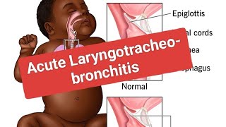 Croup Acute Laryngotracheitis  Acute Laryngotracheobronchitis [upl. by Anoi719]