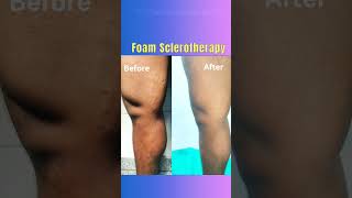 Treatment of varicose veins Foam Sclerotherapy treatment of varicose veins shorts varicoseveins [upl. by Bellamy]