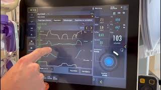Het berekenen van de occlusie druk en predicted transpulmonaal druk ServoU [upl. by Goodrow515]