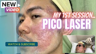 My First Session with Pico Laser Treatment [upl. by Jess]