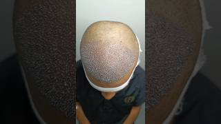 3000 grafts Hair Transplant for High confidence boosting [upl. by Downey]