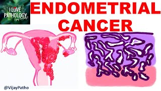 ENDOMETRIAL CARCINOMA Risk factors Etiopathogenesis Morphology amp Clinical features [upl. by Ahsaret321]