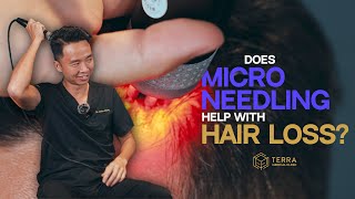 Is Microneedling The Cure For Hair Loss [upl. by Ecinereb426]