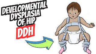 Developmental Dysplasia of the Hip DDH  Diagnosis and Treatment [upl. by Arley]