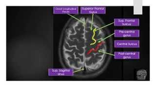 MRI Brain Sectional Anatomy Section 2 [upl. by Thanh]