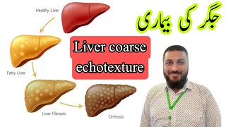 Coarse echotexture liver  chronic liver disease  hepatitis fatty liver [upl. by Enogitna116]