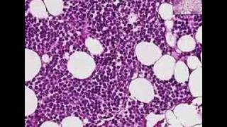 Histopathology BoneMultiple myeloma [upl. by Enelaehs]