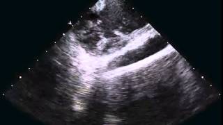 HandsOn Ablation  Video 125 [upl. by Eniluap]