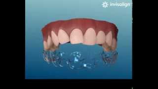 Video Dimostrativo Invisalign [upl. by Caritta]