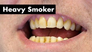 Cleaning Smokers Teeth with Heavy Stain  Teeth Cleaning [upl. by Coy]