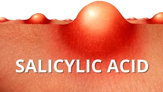 Heres WHY Salicylic Acid is Best For ACNE [upl. by Onitsoga]