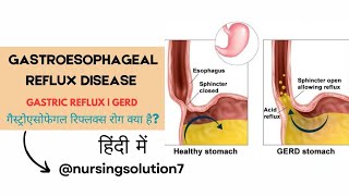 Gastroesophageal reflux disease in hindi  GERD  Cause  Symptom  Treatment  Acid reflux in hindi [upl. by Ainesy]