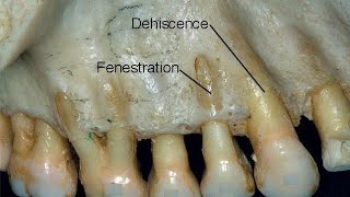 Fenestration amp Dehiscence [upl. by Cowley457]