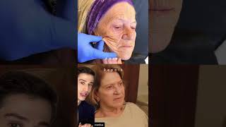 SHOCKING Chemical Peel Results dermreacts [upl. by Eriuqs]