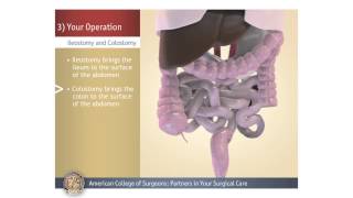 ColostomyIleostomy Your Operation [upl. by Stearn]