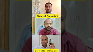 Before And After Hair Transplant surgery Shorts videos [upl. by Ocirnor]