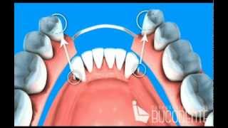 Bucodente Prótesis mixta con ataches [upl. by Ainimre]