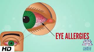 Eye Allergy Causes Signs and Symptoms Diagnosis and Treatment [upl. by Manson]