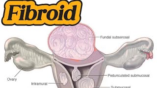 Uterine Fibroid  Mass Uterus  DUB on ultrasound [upl. by Heti]