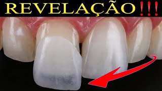 Qual a diferença de VALORES entre LENTE de CONTATO DENTAL de RESINA e LENTE DE PORCELANA 4 [upl. by Mccahill]