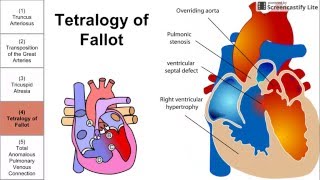 Cyanotic Congenital Heart Diseases [upl. by Ahsilram]