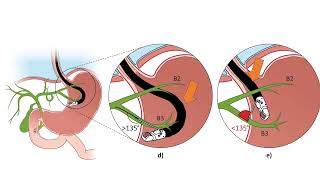 EUSguided hepaticogastrostomy practical tips and tricks [upl. by Yeneffit520]