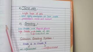 Prostate Carcinoma Pathology  Morphology and Gleason Grading [upl. by Gilman]