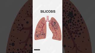 Hazards of Silica Exposure occupationalhazard silicaexposure healthsafety [upl. by Eicnahc]