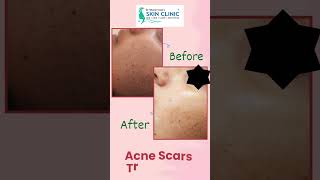 Acne Scars Treatment  Dr Bhoomi Goel  Public Hospital [upl. by Emerald]