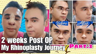 2 Weeks Post Op My Rhinoplasty Journey Part 2 by Doc Ferdinand Lacson Kosmed [upl. by Dloniger677]