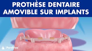 Prothèse dentaire amovible sur implants © [upl. by Whitver]