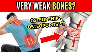 5 TIPS TO IMPROVE OSTEOPENIA and OSTEOPOROSIS  SYMPTOMS OF WEAK BONES [upl. by Lartnom452]