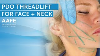 NonSurgical Face and Neck Lift with PDO Lifting Threads  AAFE [upl. by Werdnael537]