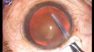 SMALL INCISION CATARACT SURGERY [upl. by Clerc]