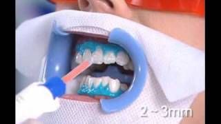 Teeth whitening Beirut Lebanon  Hollywood Smile Ferrari Dental Clinic [upl. by Irual]