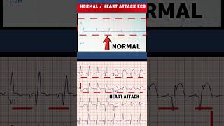 हार्ट अटैक का ECG  HEART ATTACK ECG VS NORMAL ECGshorts [upl. by Yorled]