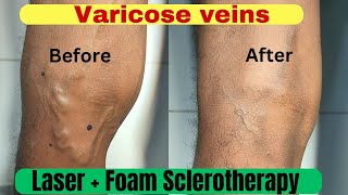 Varicose veins treatment  3 month follow up result Laser treatment  Foam Sclerotherapy treatment [upl. by Triley]