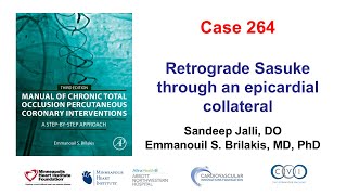 Case 264 Manual of CTO PCI Retrograde Sasuke through an epicardial collateral [upl. by Torbert]