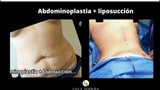 Cuidados después de una abdominoplastia y lipo escultura con bbl [upl. by Lyrej]