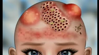 ASMR Remove Worm amp Maggot Head Infected  Severely Injured Animation [upl. by Etireugram]