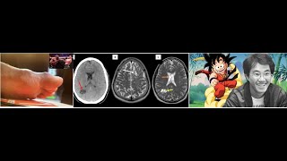 Défaite de Doumbé VERRE dans le pied mort de Toriyama CERVEAU homme avec VERS dans le CERVEAU [upl. by Auqinihs255]