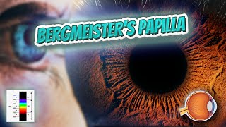 Bergmeisters papilla  Your EYEBALLS  EYNTK 👁️💉😳💊🔊💯✅ [upl. by Zetrauq731]